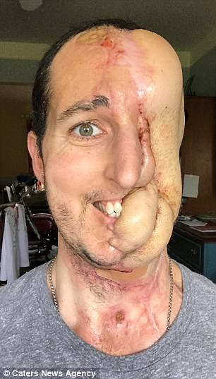 38歲帥哥某天下巴痛「之後左臉就被全部吞噬」，3年後家人都不敢相信他會長這樣…