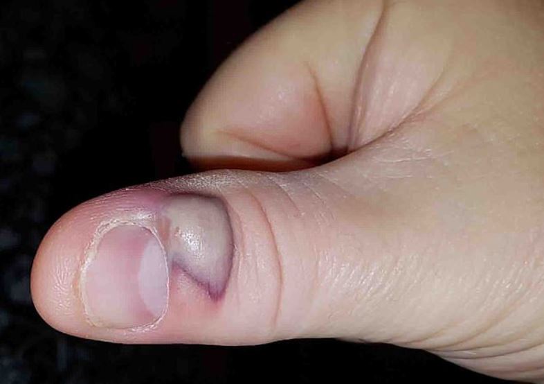 57歲阿公愛咬指甲「全身被侵蝕」　送醫聽到這個病症絕望了