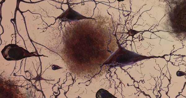 得了失智症必死？　醫界研究重大突破　成功治癒老鼠的阿茲海默症