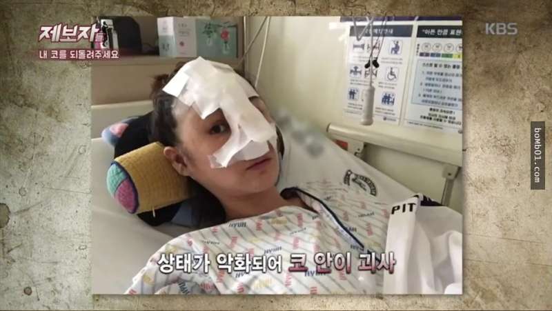 韓國女生隆鼻隆到一半告訴醫生無法呼吸，結果醫生堅持說沒事後…她現在的鼻子爛到超嚇人！