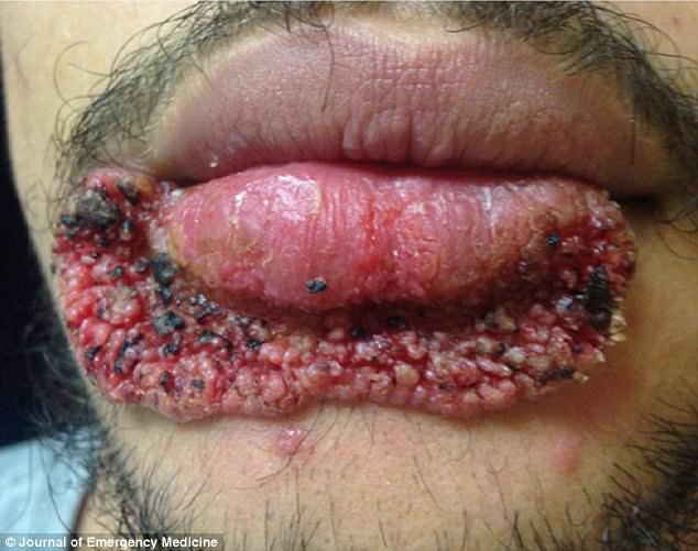 他用錯方法擠痘痘「嘴巴變得越來越不正常」，7個月後身心靈都受不了才決定去找醫生