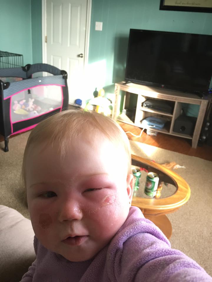 這個媽媽沒注意幫14個月大女兒擦了「這個產品」，隔天看到女兒竟然發現她已經嚴重灼傷！