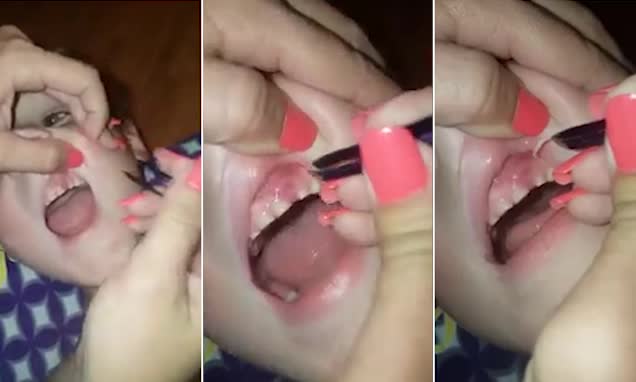 這個媽媽在「愛咬指甲」的兒子牙齦上夾出深嵌指甲，數量多到差點以為兒子是否變成了怪物！
