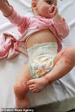 1歲愛女被親一口冒「紫紅色斑點」送急診　醫生示警：親她的人嘴恐有毒