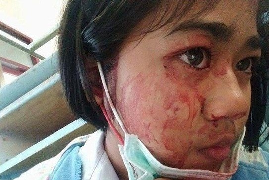 泰國少女只要一頭痛「五官和皮膚就會開始大爆血」，她罹患的「怪病」就連醫生看了也束手無策！