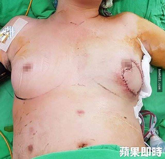台中女子只因「小時候出過車禍」長大後竟然乳房潰爛，34D巨乳現在半個乳房被挖掉！