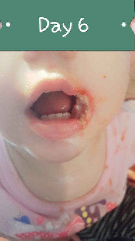 媽媽PO照警告！19個月大女兒「只是舔了手機充電器」，她當晚就無助的看著女兒嘴角潰爛！