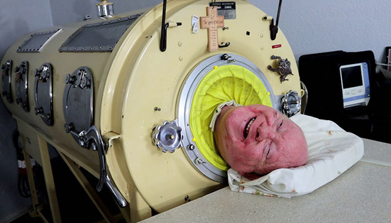困「鐵肺」70年破世界紀錄！美傳奇勵志男離世　享壽78歲