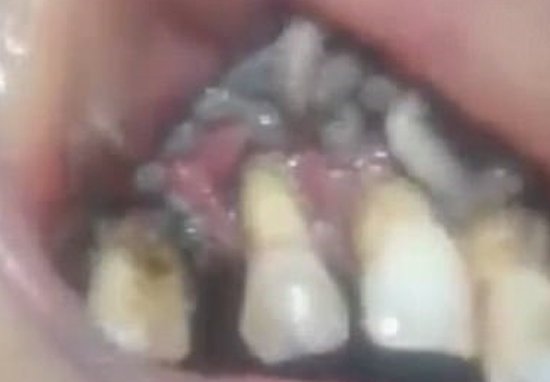 噁…牙醫看到病人滿口爛牙已經習以為常，但下一秒看到瘋狂蠕動的活蛆嚇到手抖！