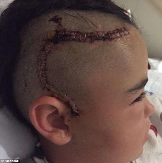 小男孩騎腳踏車摔了一跤時爸媽都看不出異常，直到2天後在兒子頭部發現的東西把他們都嚇壞了！