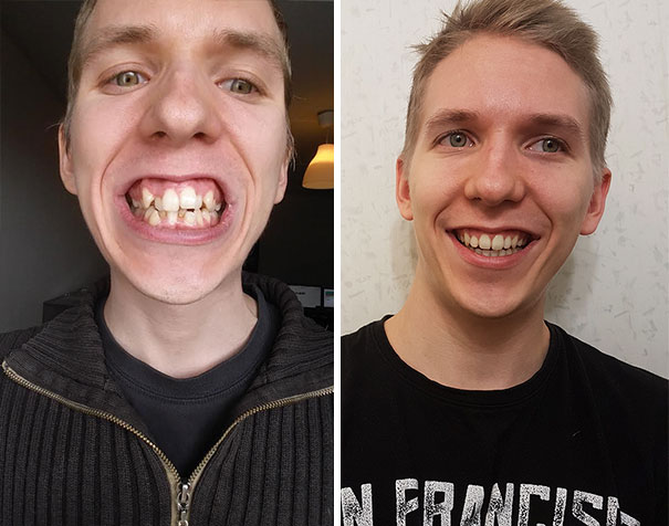 10張「拆掉牙套，大家都誤以為他們去整形回來」的對比圖