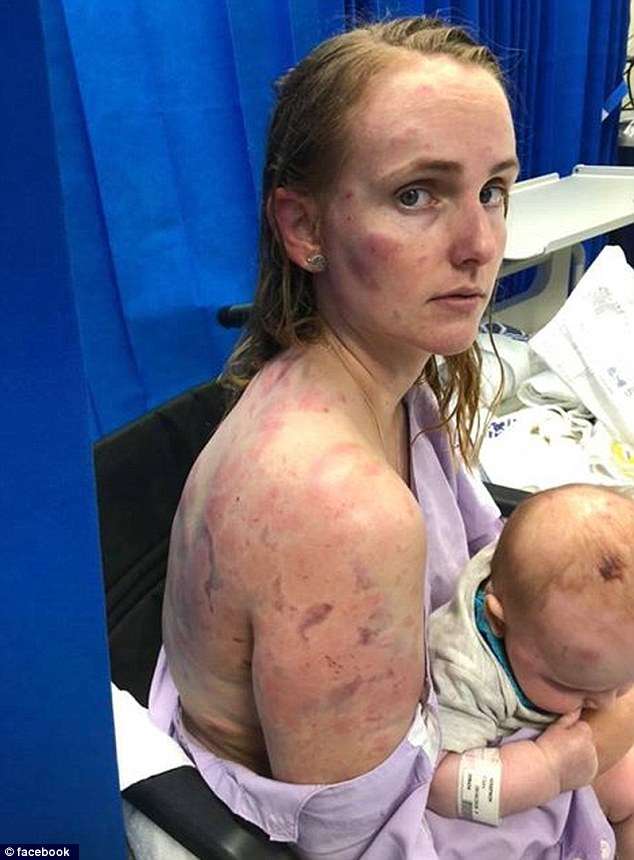 澳洲突爆砸冰雹雨！　勇母「以身護幼女」被砸到全身瘀傷