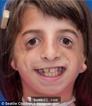無臉症女孩9歲時終於在頭部動了手術，術後她的「特開心表情」也讓所有人露出大大的笑容了！