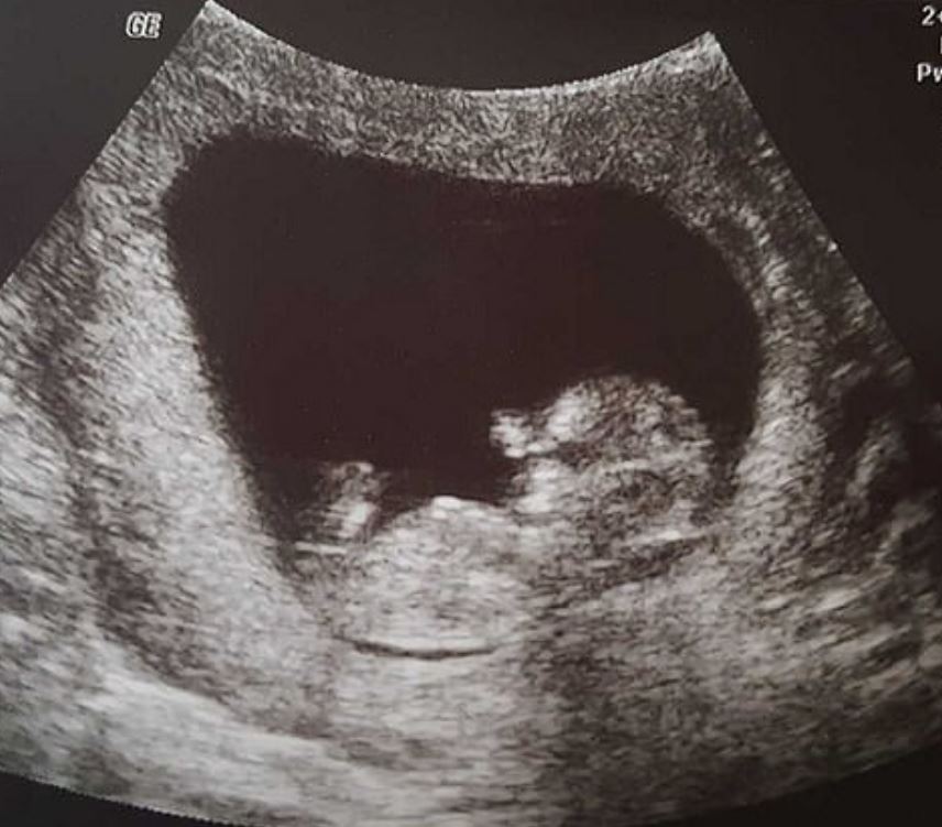 「這是我14週寶寶的小手」　媽媽心碎上傳照片：在醫生眼中竟然是垃圾