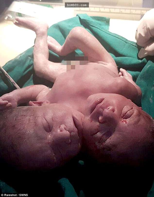 媽媽在生產前一天才發現肚子裡的寶寶「有兩個頭」，生產後醫生的話讓她心都裂了…