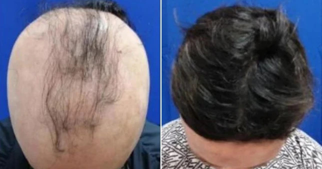 禿子有救了！美國研發新藥「每日2片」　4成患者半年內長出頭髮