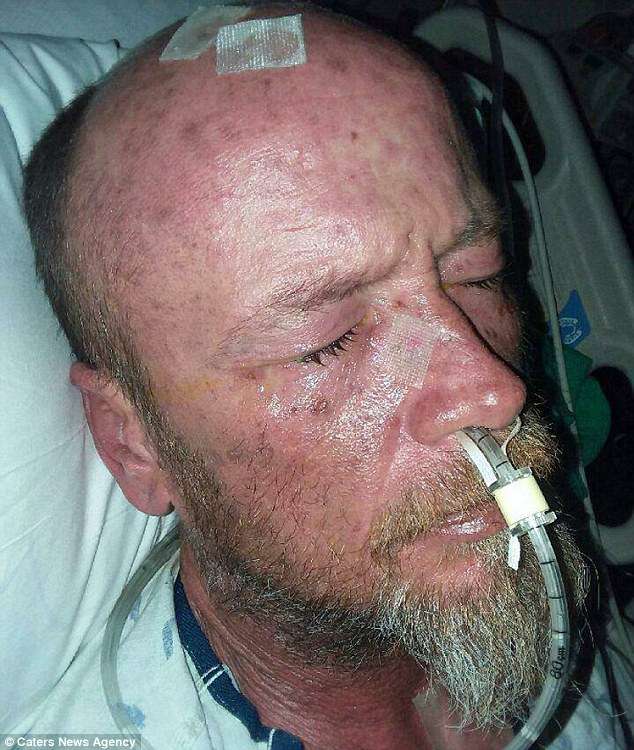 吃抗生素變「喪屍」　38歲男蛋蛋都是濃液　全身皮膚潰爛連家人都害怕
