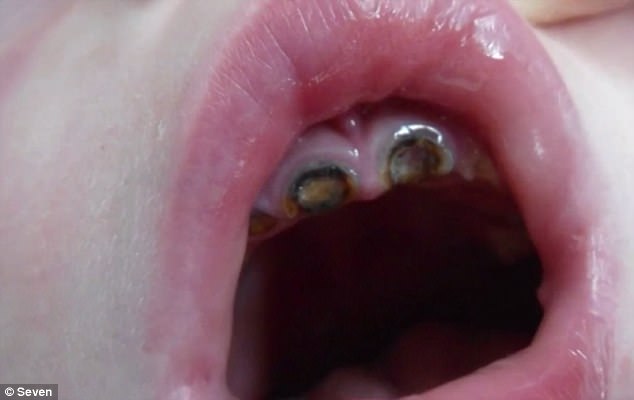 1歲小寶寶「吃甜食結果牙齒全部爛掉」，心痛的牙醫還提醒家長「睡前喝奶都會造成牙齒爛掉」！