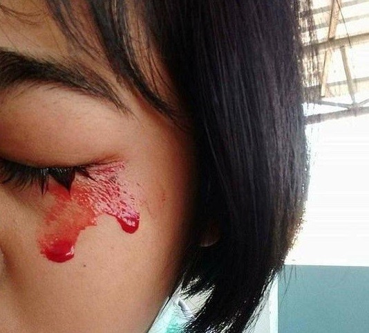 泰國少女只要一頭痛「五官和皮膚就會開始大爆血」，她罹患的「怪病」就連醫生看了也束手無策！