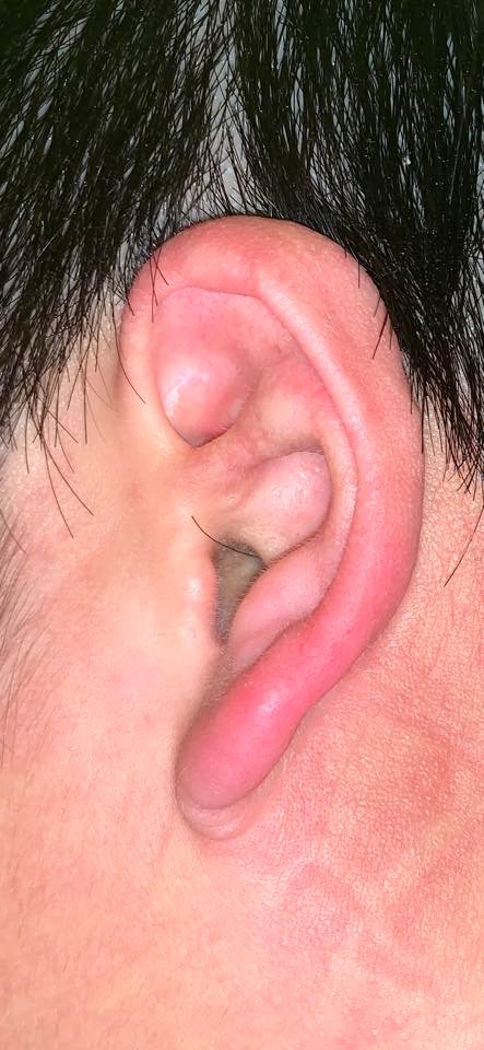 左耳出現小強觸角…男子花850元掛急診　醫生愣：只是一根頭髮啊