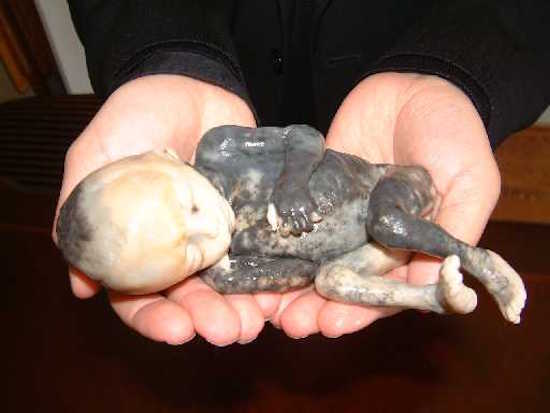 婦產科護士分享那些在墮胎手術「倖存」的嬰兒，沒有死掉的他們…其實比死亡更慘！