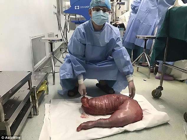 22年宿便卡在腸子！　男子腹部「腫成孕婦」　醫生切除腸子發現重達15公斤