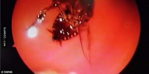 印度女子雙眼灼熱偏頭痛半夜驚醒，緊急檢查後竟發現「有蟑螂跑進眼睛裡了」！