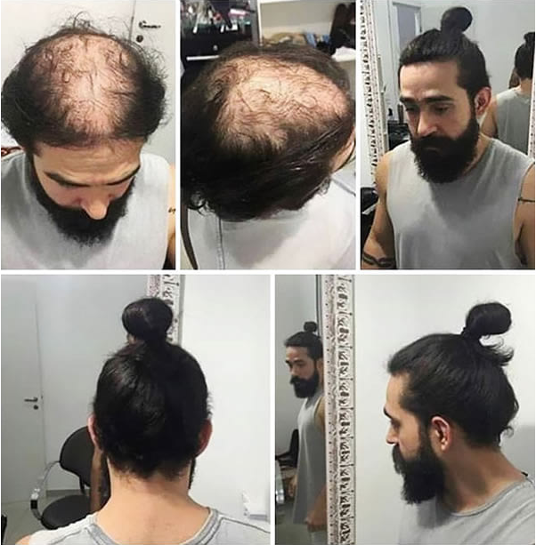 這就是超潮的「Man Bun」髮型下不為人知的情況，有脫髮問題的人都是靠它重生啊！