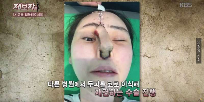 韓國女生隆鼻隆到一半告訴醫生無法呼吸，結果醫生堅持說沒事後…她現在的鼻子爛到超嚇人！