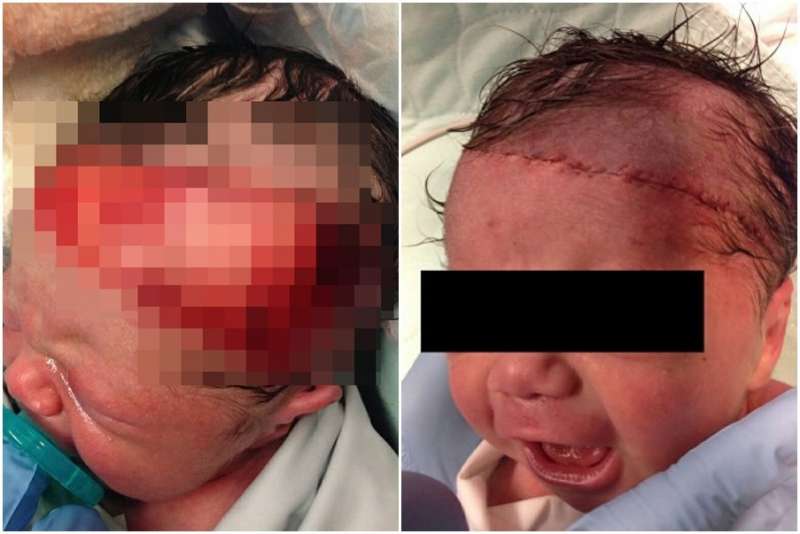 醫生緊急剖腹「切開胎兒頭皮」　額頭留下「17公分刀傷」讓網友嚇壞：我不敢看