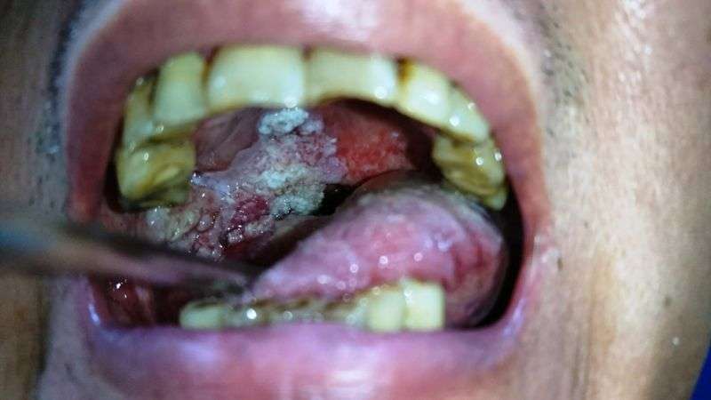 跨國研究第一次證實「吃檳榔會上癮」　每天嚼檳榔的人口腔癌風險高153倍