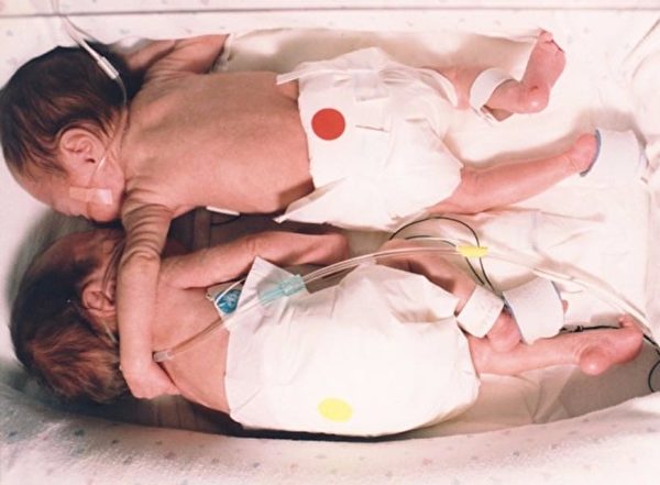 護士將瀕死的早產寶寶放在雙胞胎姐妹身旁，然後她親眼看著寶寶慢慢恢復了正常的呼吸跟心跳…