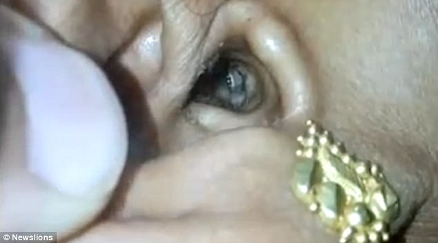 印度女子耳朵疼痛就醫，醫生竟然從她耳朵裡取出一隻活蜘蛛！