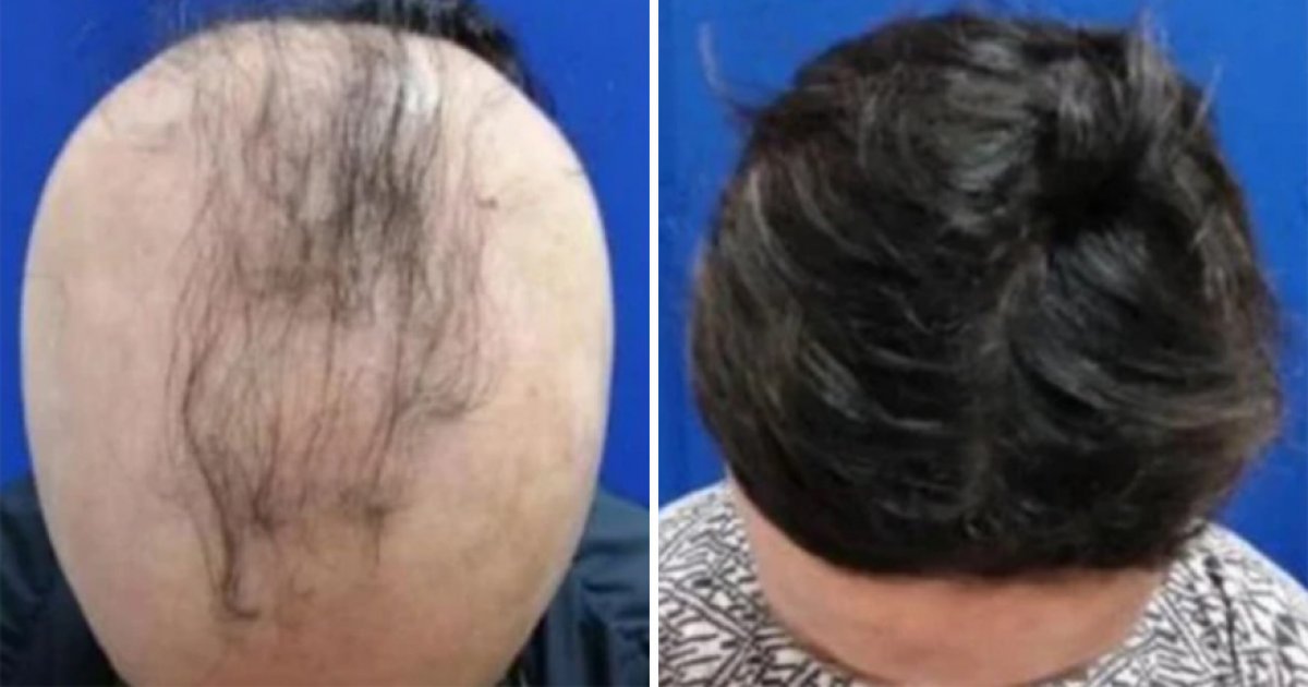 禿子有救了！美國研發新藥「每日2片」　4成患者半年內長出頭髮