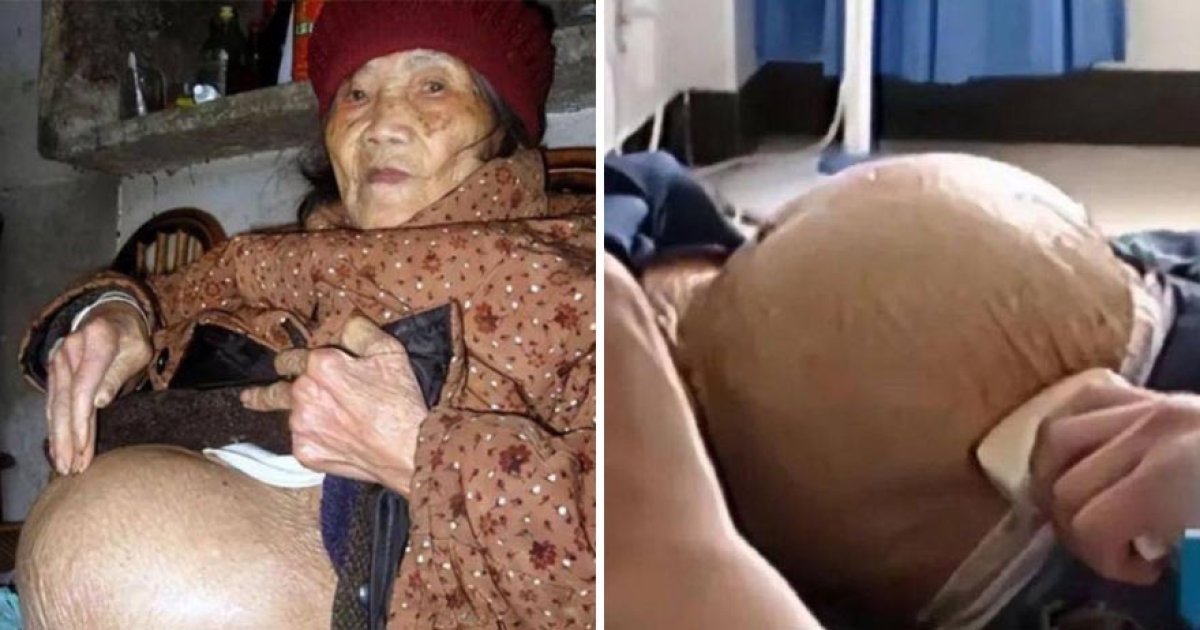91歲阿嬤跌倒送醫！X光一照發現「懷孕了」：腹中有完整胎兒