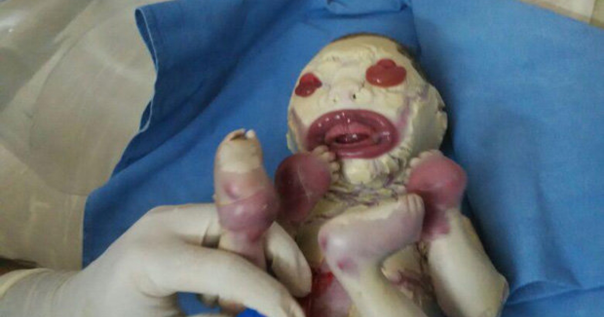 醫生驚駭地從這個媽媽的子宮中抱出「全身覆蓋著殼的寶寶」，醫療團隊都很吃驚寶寶竟能活著出生！