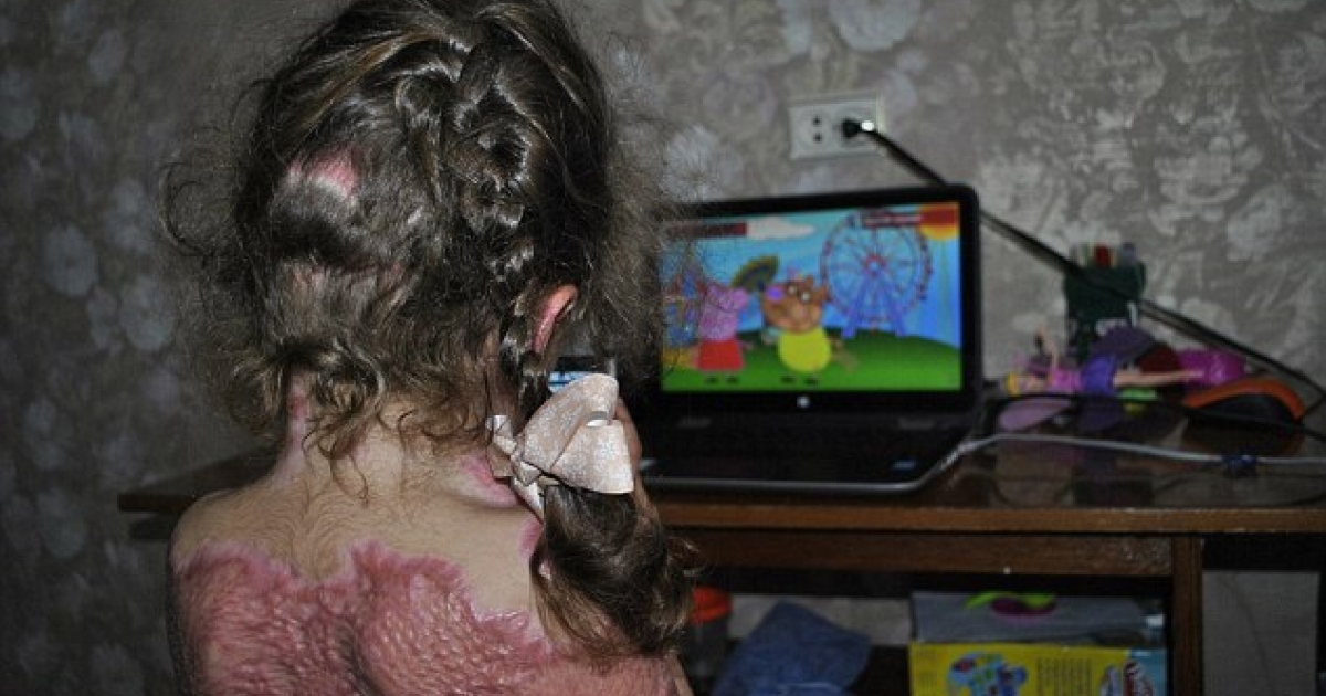 5歲小女孩在網路接觸「自殺遊戲」結果照著指導做傻事，她差點被燒死的傷勢讓爸媽都嚇傻了！