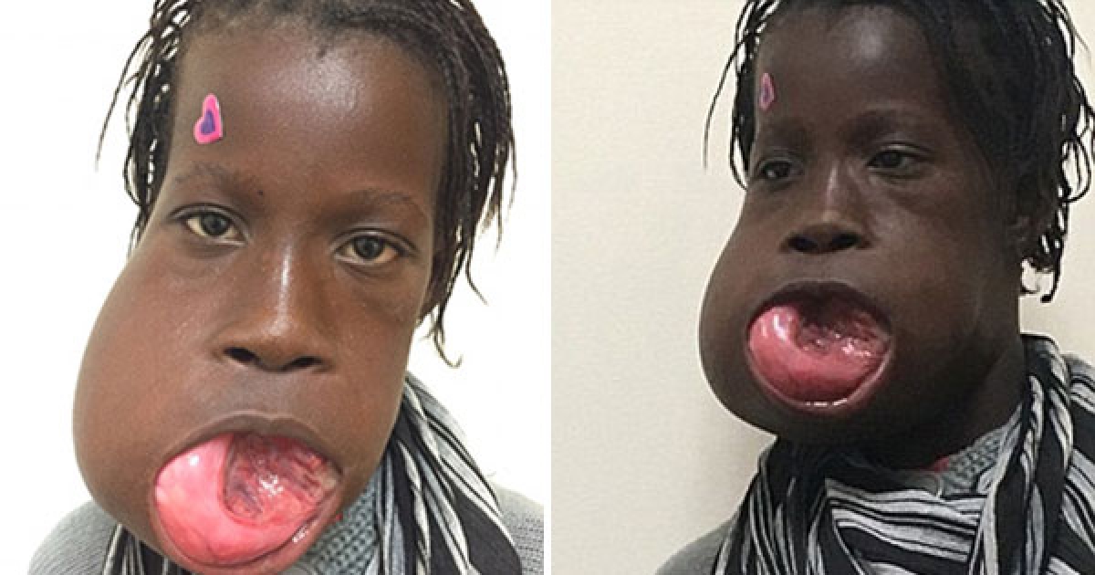 這個小女孩的嘴巴上長了2.7kg的腫瘤當地人都認為沒救，沒想到她現在竟然變成了這樣子！