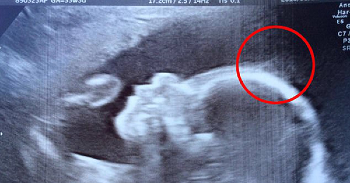 醫生在超音波螢幕就發現「這個寶寶的髮量驚人」，出生4個月後髮量果然多到超治癒人心啊！