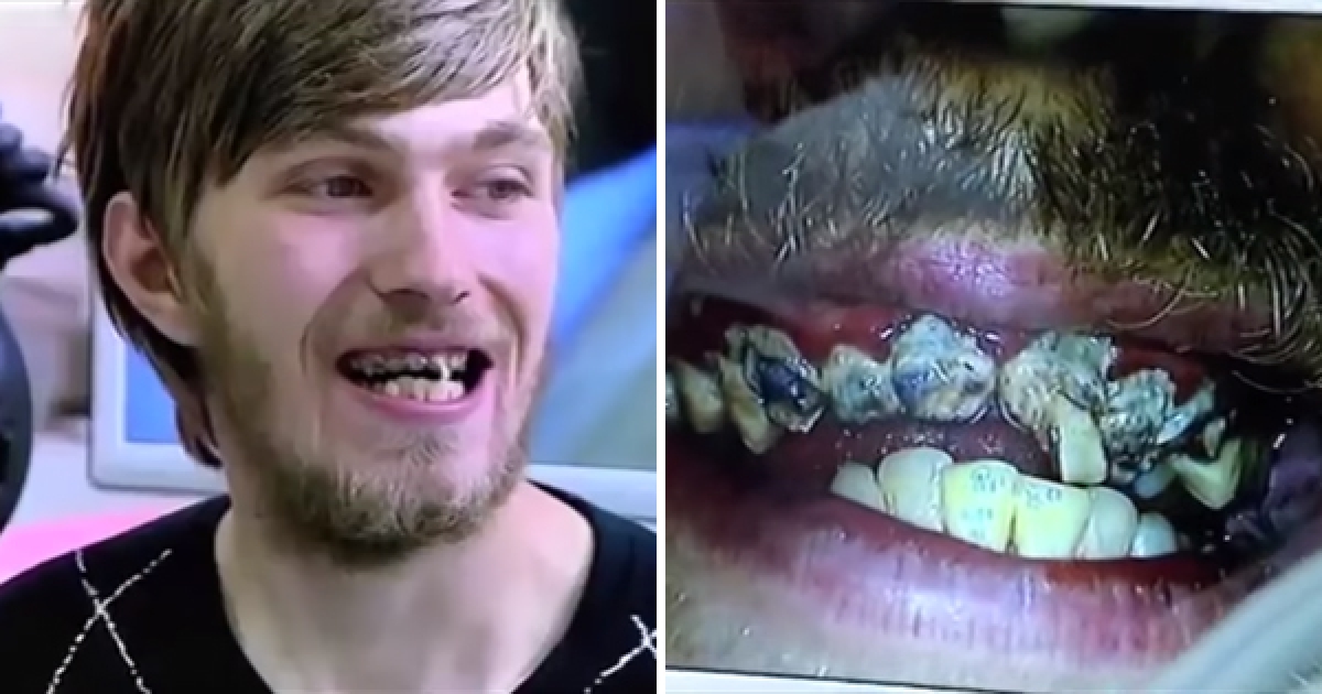 這個男子「20年來完全沒有刷過牙齒」，他一張開嘴巴連牙醫也後退300步！